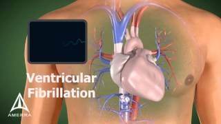 Défibrillation dune fibrillation ventriculaire [upl. by Ille]