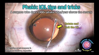 CataractCoach™ 2282 phakic IOL tips tricks [upl. by Ihdin]