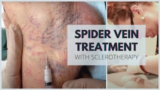 Sclerotherapy  Spider Veins Treatment at Vein Health Vein Clinic [upl. by Leopoldine]