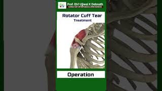 Treatment of rotator cuff tear   Dr Ujjwal K Debnath [upl. by Shalna]