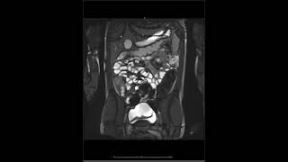 Crohns Disease  Active Inflammation Overview [upl. by Rogovy]