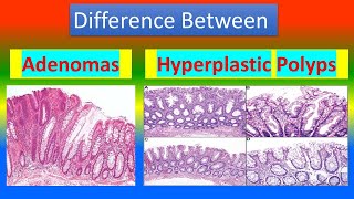 Difference Between Adenomas and Hyperplastic Polyps [upl. by Sivrat]