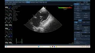 IQ 306 TSI TISSUE SYNCHRONY IMAGING ECHOPAC ANALYSIS ECHOCARDIOGRAPHY HEPATOMA PTE [upl. by Mohandas]