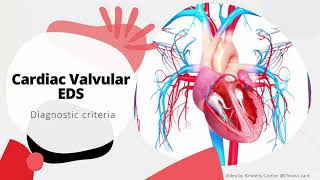 CardiacValvular Ehlers Danlos Syndrome Diagnostic Criteria [upl. by Cima965]