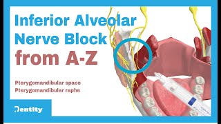 Inferior Alveolar Nerve Block  AZ [upl. by Onileba605]