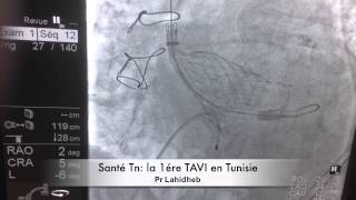 La 1ère TAVI en Tunisie [upl. by Eilsek]