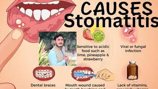 Stomatitis Chapter1 Disease1 AHN 3rd semester kmu slides in pashto drnajeebnote drnajeeb kmupdat [upl. by Morita]