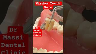 Wisdom Tooth Surgical  flap bone removal and Sectioning [upl. by Gottfried]