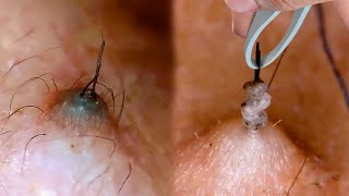 How to Prevent amp Treat Ingrown Hairs [upl. by Odnesor917]