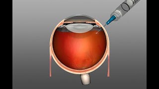 Spritze ins Auge  bei AMD diabetischem Makulaödem retinalen Gefäßverschlüssen [upl. by Thar]