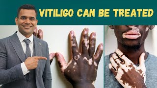 Vitiligo Leucoderma  Can Be Treated  Herbs And Vitamins To Treat Vitiligo  Dr Vivek Joshi [upl. by Divd]