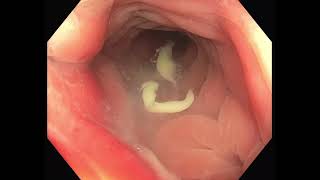 Diverticulitis aguda complicada con absceso diverticular [upl. by Truman343]