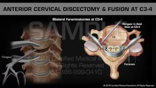 Anterior Cervical Discectomy amp Fusion at C34 [upl. by Aloisia901]