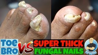 Trimming of Super Thick Fungal Nails FULL TREATMENT [upl. by Barger]