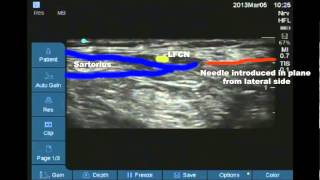 Ultrasound guided lateral femoral cutaneous nerve of thigh block [upl. by Katalin]