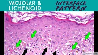 Vacuolar vs Lichenoid Interface Dermatitis Pattern  Inflammatory Dermpath Basics [upl. by Henigman]