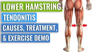 Three Simple Distal Hamstring Tendinopathy Exercises [upl. by Ahsekar]