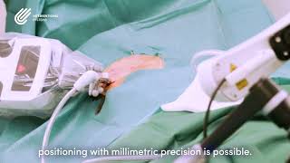 Micromate™ Case Testimonial  Liver Microwave Ablation [upl. by Arathorn]