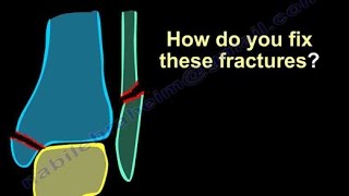 Ankle Fractures Surgical Treatment tactics  Everything You Need To Know  Dr Nabil Ebraheim [upl. by Nomad]