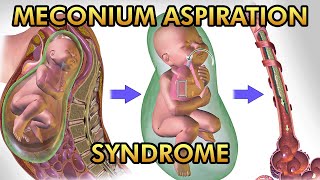 Meconium Aspiration Syndrome Pathophysiology Signs and Symptoms Diagnosis and Treatment [upl. by Saum]