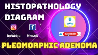 Histopathology diagram of Pleomorphic Adenoma [upl. by Maurer]