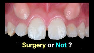 Solving Upper Impacted canines｜【Chris Chang Ortho】CC792 [upl. by Ltney404]