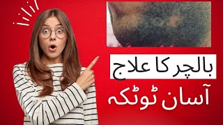 What is AlopeciaHow to treat AlopeciaBal char ka mukaml ilaj hair loss sirf ek chez syUrdu Hindi [upl. by Anatnas545]