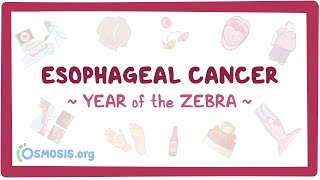 Esophageal Cancer Year of the Zebra [upl. by Mohammed699]