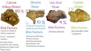 Kidney Stones  Types and Causes of Kidney Stones Symptoms and prevention [upl. by Ainniz677]