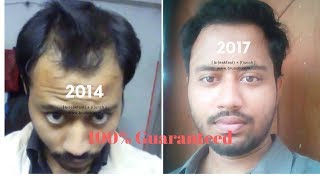 Regrow hair naturallyWith Video Proof2014 vs 2017 [upl. by Ekralc]