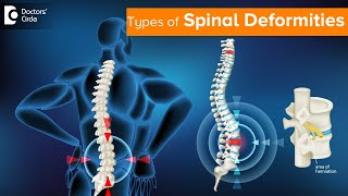 Types Of Spinal Deformities How Are Spine Deformity Correction Done  Dr Kodlady Surendra Shetty [upl. by Koran]