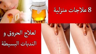 8 وصفات منزلية لعلاج الحروق و الندبات البسيطة [upl. by Alva]