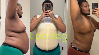 SURGERY VLOG  I got Liposuction  Day 17 Post Op [upl. by Eaned347]