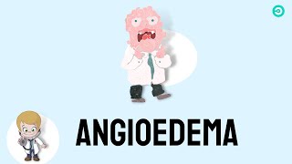 Angioedema signs amp symptoms causes and treatment [upl. by Hy]