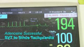 SVT or Supraventricular Tachycardia [upl. by Adelle]