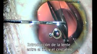 Lente intraocular para el tratamiento de la miopia hipermetropia y astigmatismo [upl. by Sydney755]