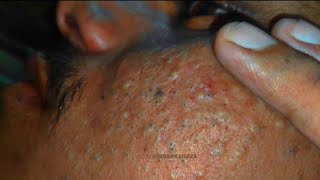 sac be spa blackheads elderly 2024  sac be spa old age blackheads acne  sac be spa face today 666 [upl. by Inverson81]