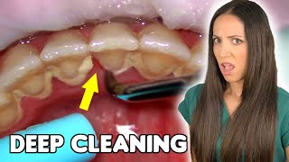 Deep Cleaning With HEAVY Tartar Build Up At The Dentist [upl. by Eirruc]