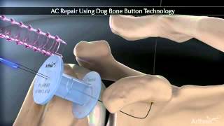 Acromioclavicular Joint repair Using Arthrex Dog Bone Button [upl. by Koralle359]