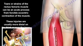 Hip Pain Strain Of The Rectus Femoris  anatomy  Everything You Need To Know  Dr Nabil Ebraheim [upl. by Radmen127]