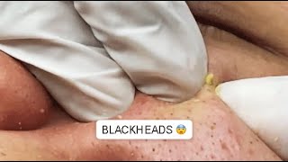 THE MOST VIEWA FACE FULL OF BLACKHEADS SATISFYING VIDEO 2 [upl. by Rugg895]