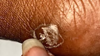 ASMR DRY SKIN FLAKY PATCH PEELING  HUGE FLAKES [upl. by Ingraham867]