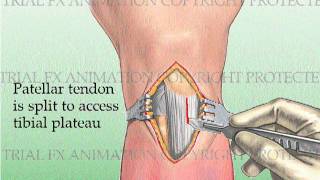 Tibial Fracture repair with Titanium Intramedullary Rod [upl. by Bollay]