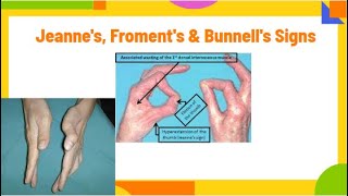 jeannes froments amp Bunnells signs  ulnar neuropathy PhysiotherapyKnowledge [upl. by Pagas445]