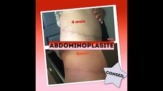 ABDOMINOPLASTIE  COMMENT GÉRER LOEDEME ET SA CICATRICE [upl. by Yennaiv76]