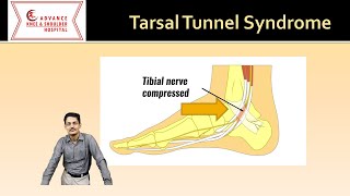 Tarsal tunnel syndrome Everything you need to know [upl. by Vernor]