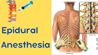 Epidural Anesthesia [upl. by Salokin]