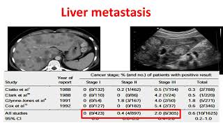 Breast cancer Staging workup part 22 Basics of Breast cancer course [upl. by Resaec]