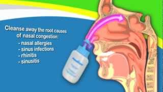 Nasal Irrigation to Treat Sinusitis Common Cold Allergy Better Than Neti Pots [upl. by Nyrhtac836]