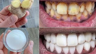 Can you whiten teeth at home in 2 minutes😁✨ Secret that Dentists dont want you to know [upl. by Aiem994]